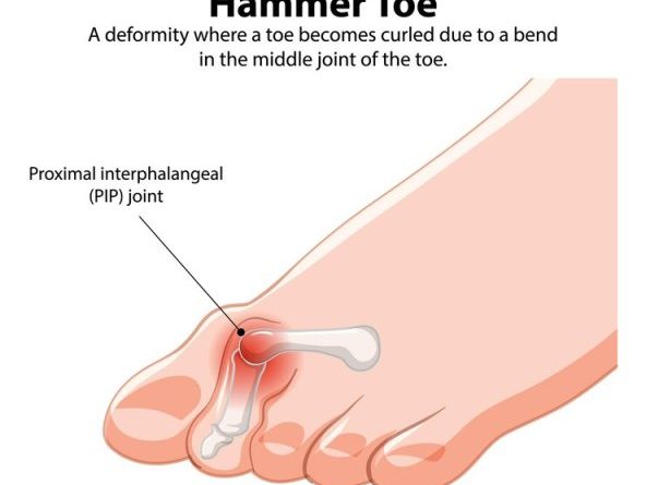 Straighten Hammer Toes at Home