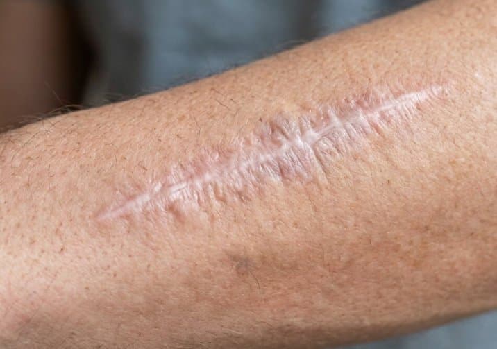 Scar Hurt Years After Surgery